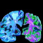 Alzheimer’s Disease