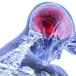 MULTIPLE SCLEROSIS (MS)